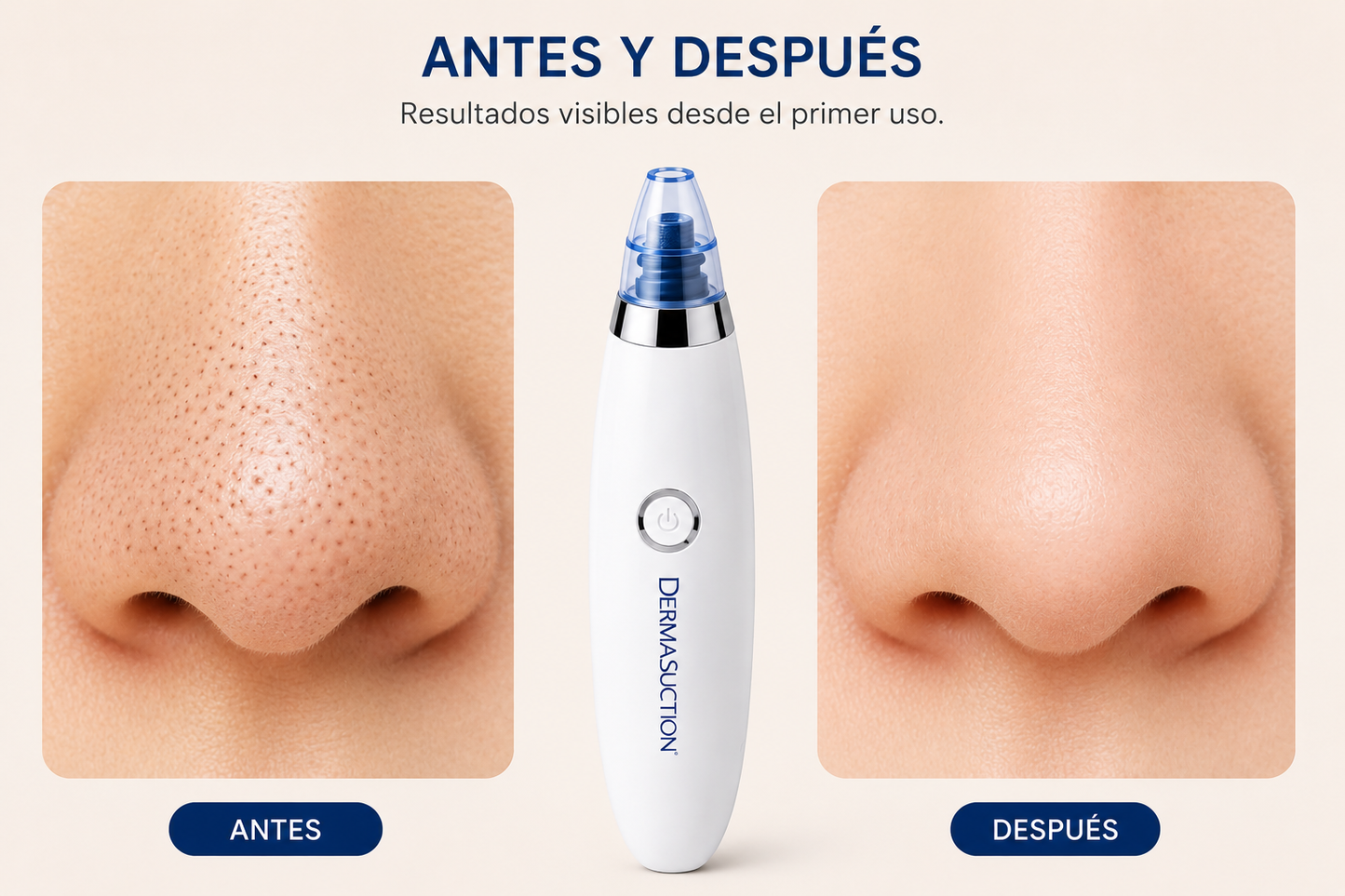 Succionador de puntos negros
