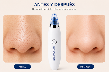 Succionador de puntos negros